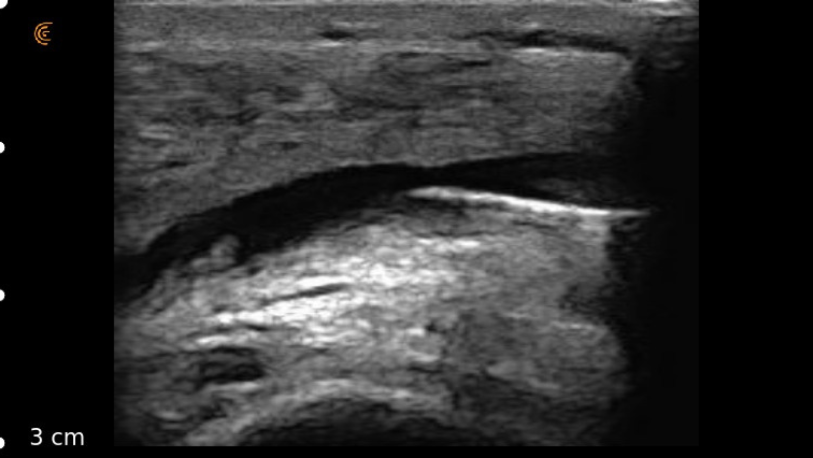 Deliver Precise Pain Management with Clarius